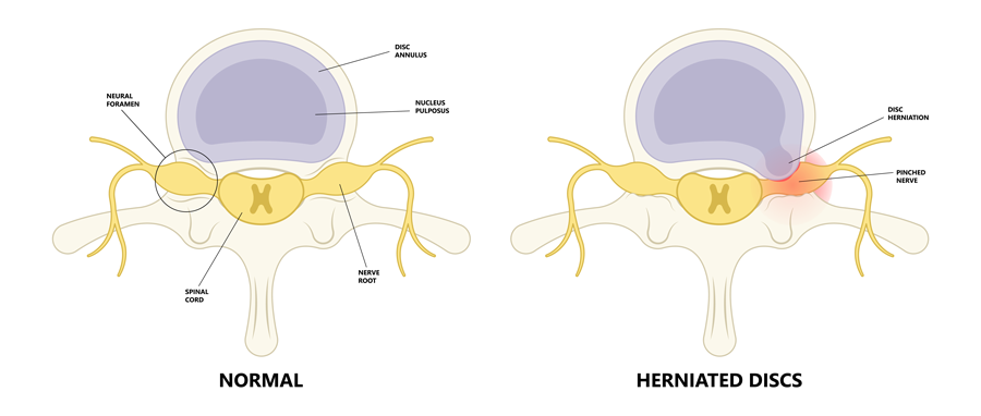 herniated-discs